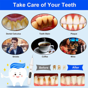 Electric-Teeth-Cleaner-Ultrasonic-Dental-Calculus-Stain-Remover-Oral-Tooth-Plaque-Tartar-Scaler-Pets-Stone-Teeth-1